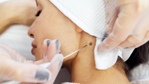 Осмотрите свои родинки все до единой: вот какой признак укажет, что пора к онкологу