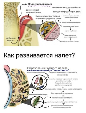 Почему налёт на зубах образуется с разной скоростью?